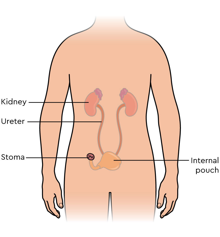 Continent urinary diversion