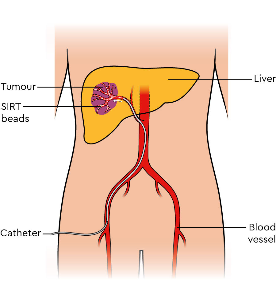 pathway of blood. The pathway of a SIRT catheter