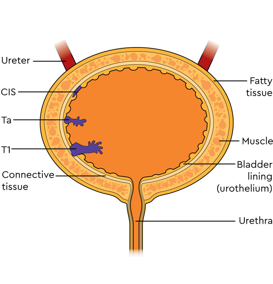 Advanced-bladder-staging