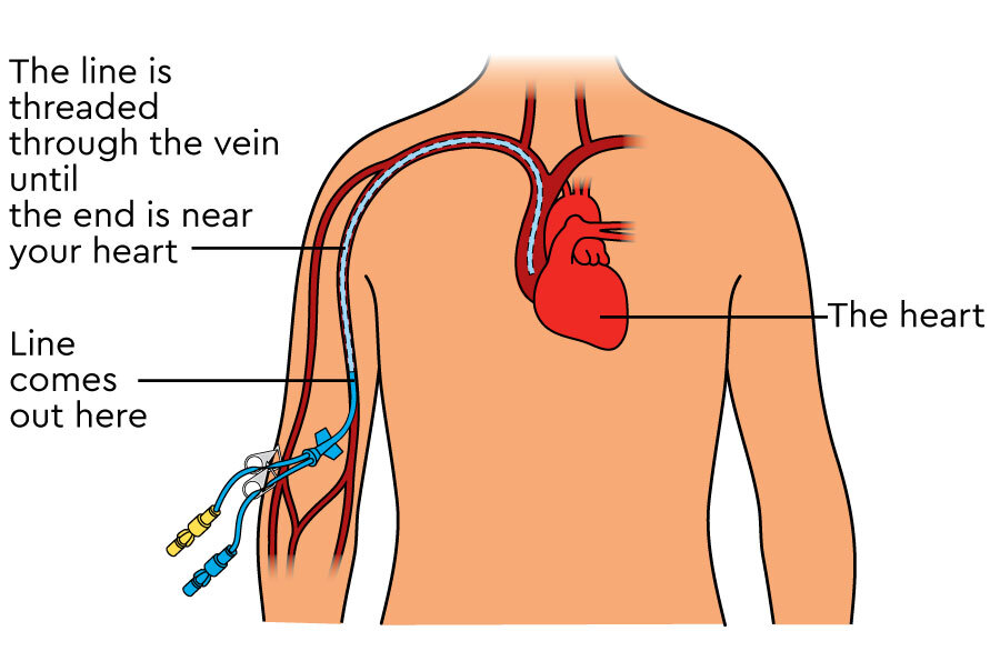 picc line - YouTube