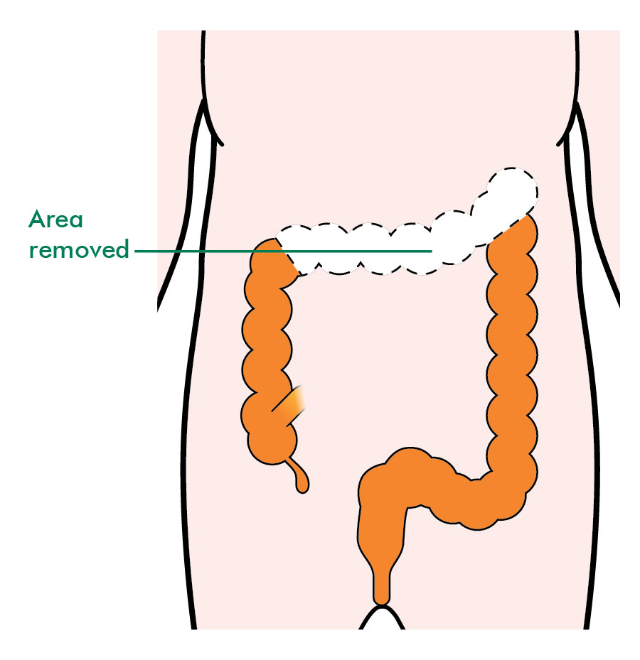 What is a colectomy surgery?