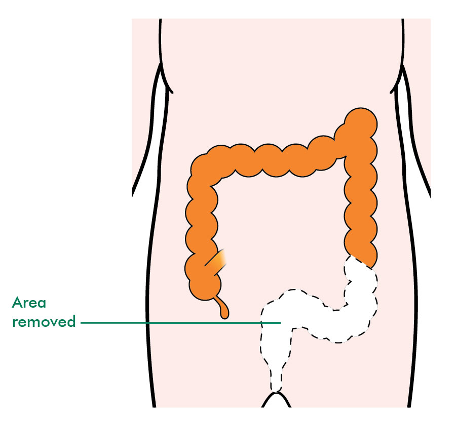 Bowel Resection Surgery And Weight Loss