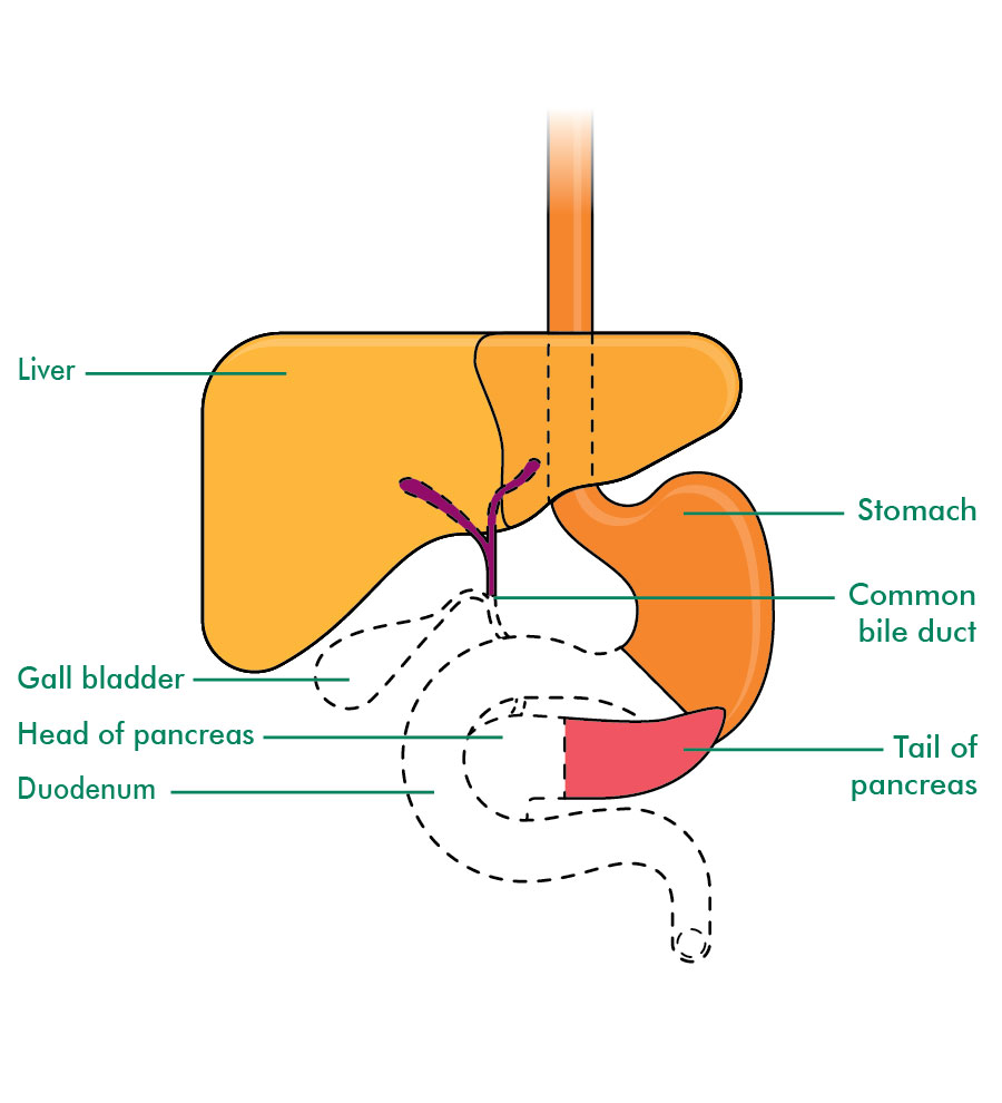 whipple procedure diagram whipple procedure diagram www imgkid the image kid whipple procedure diagram whipple procedure diagram www imgkid the image kid