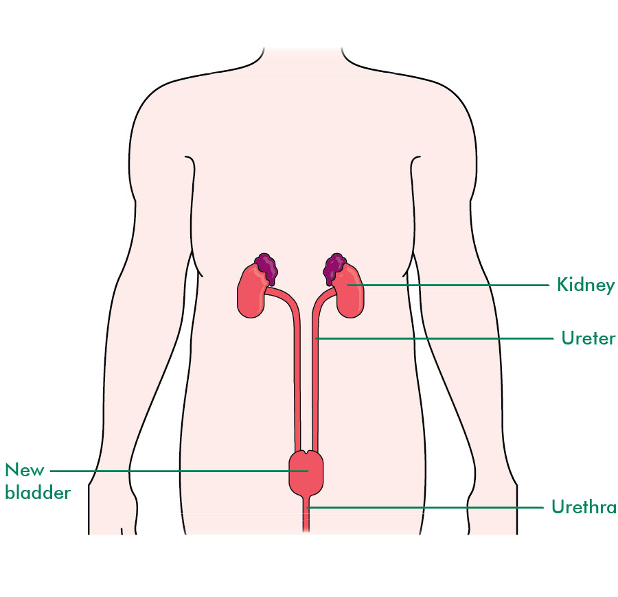 Neobladder (bladder reconstruction)