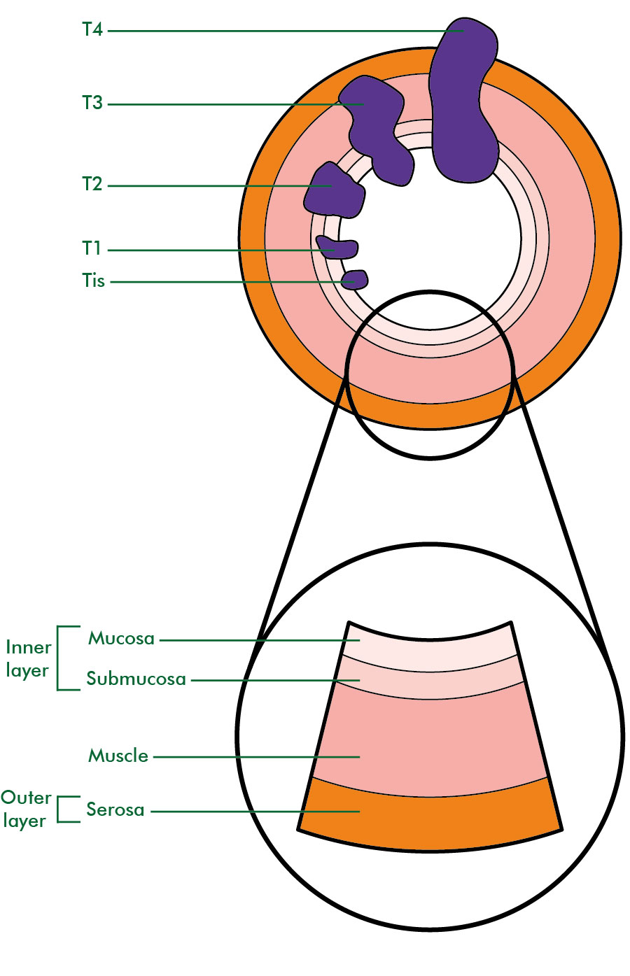 Tumor Sizes Chart Colon