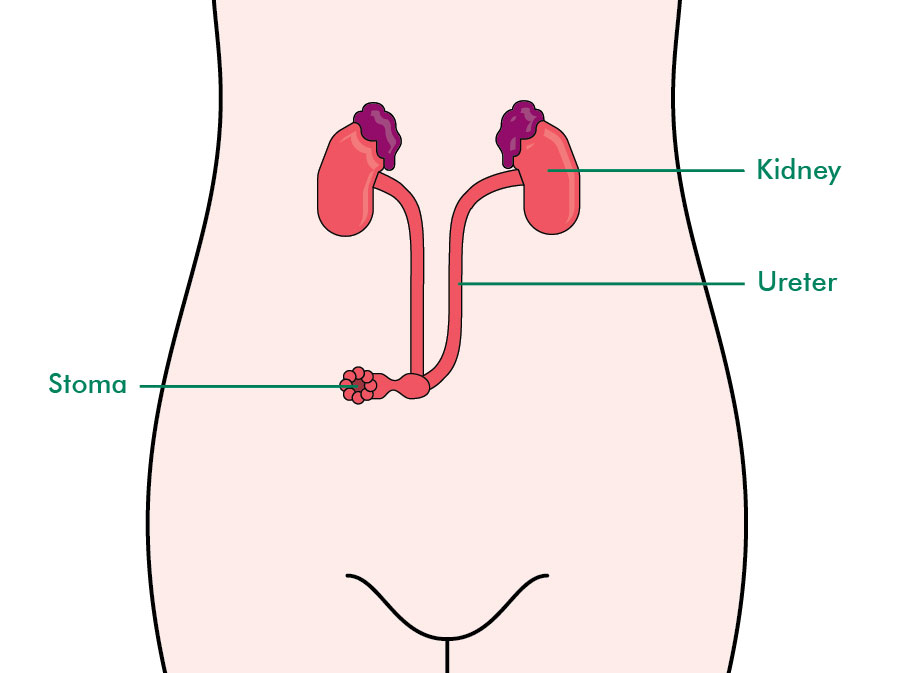 Having a pelvic exenteration Information and support Macmillan Cancer Support
