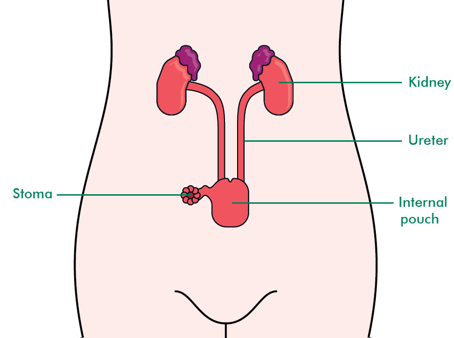 Having a pelvic exenteration Information and support Macmillan Cancer Support