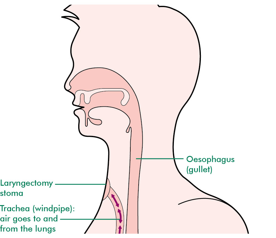 surgery for laryngeal cancer information and support macmillan laryngectomy