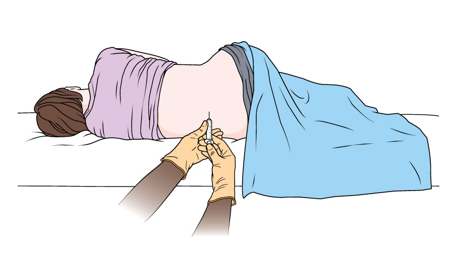 Lumbar puncture Macmillan Cancer Support