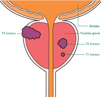 prostate cancer TNM staging