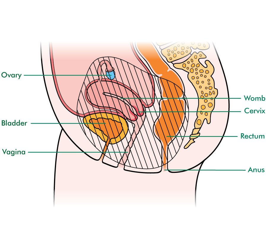Image result for Pelvic exenteration