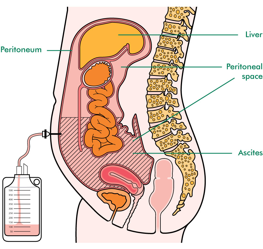 paracentesis fluid how much Support Cancer Ascites Macmillan paracentesis fluid how much Support Cancer Ascites Macmillan