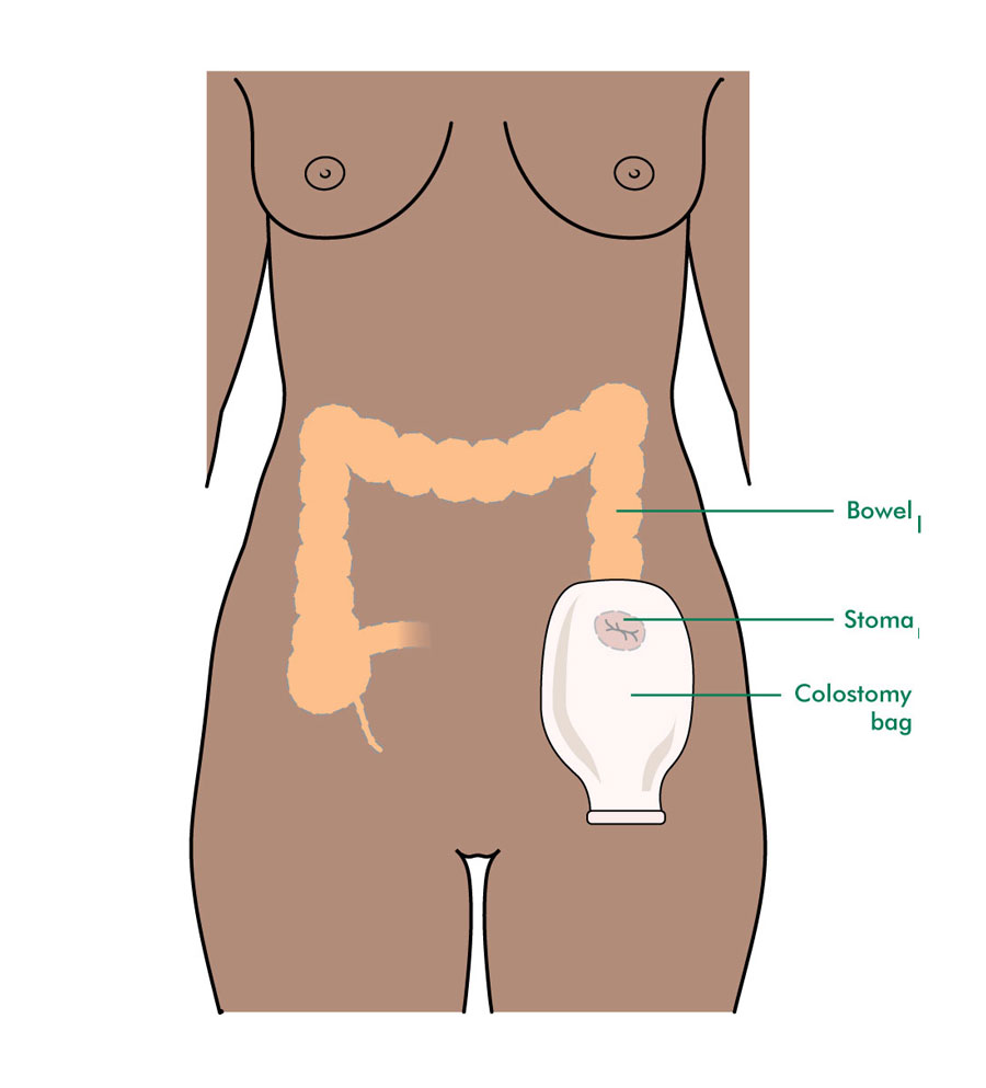 Having Pelvic Exenteration In Women Information And