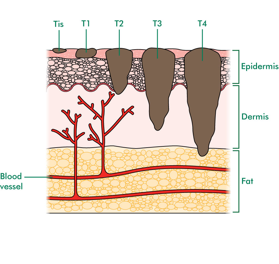 Melanoma Skin Cancer Diagram