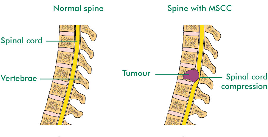 Malignant spinal cord compression (MSCC) - symptoms - Macmillan Cancer