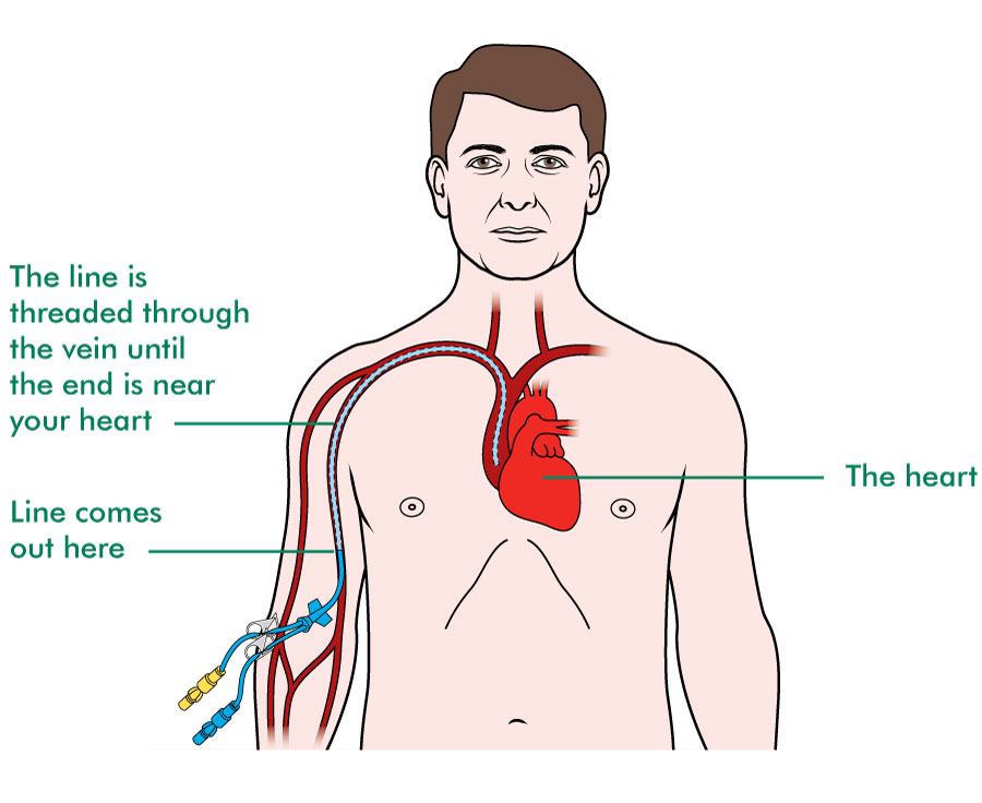 How chemotherapy is given - Macmillan Cancer Support