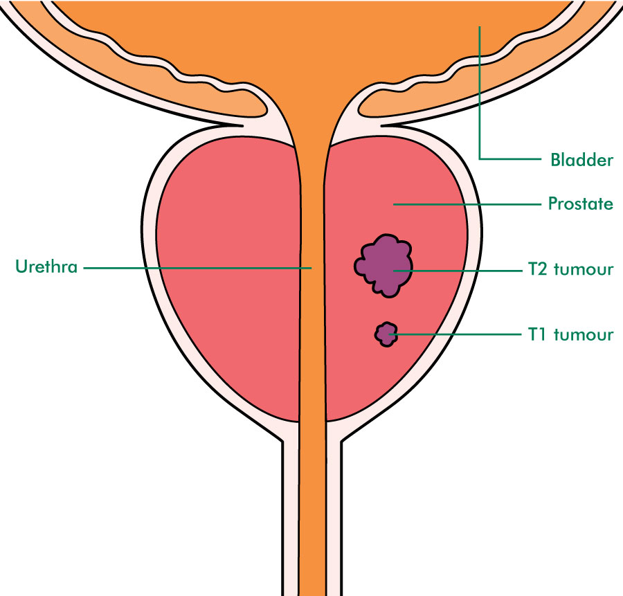 Prostate Cancer Staging And Grading