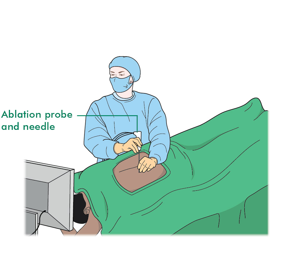 Tumour ablation for kidney cancer Macmillan Cancer Support