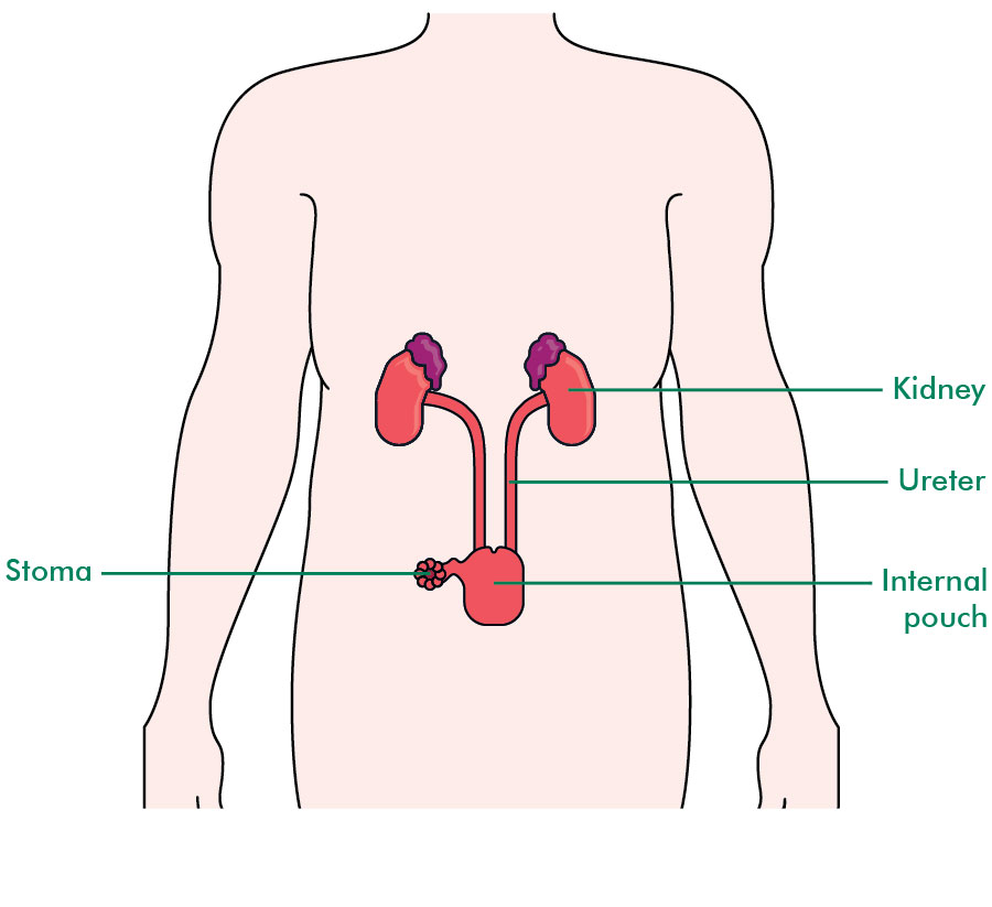 Urinary diversion operations Information and support Macmillan Cancer Support