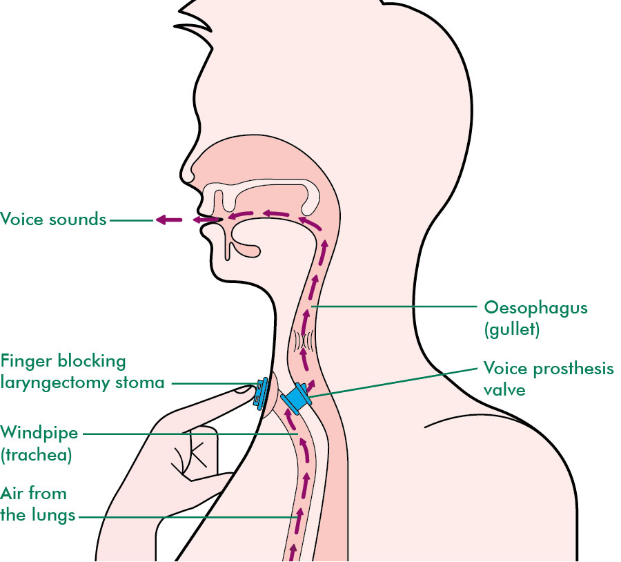 Speaking After A Laryngectomy Information And Support Macmillan