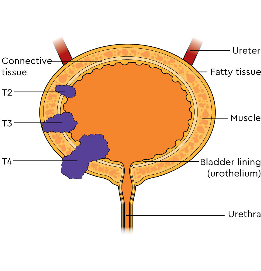 Staging muscle-invasive and advanced bladder cancer