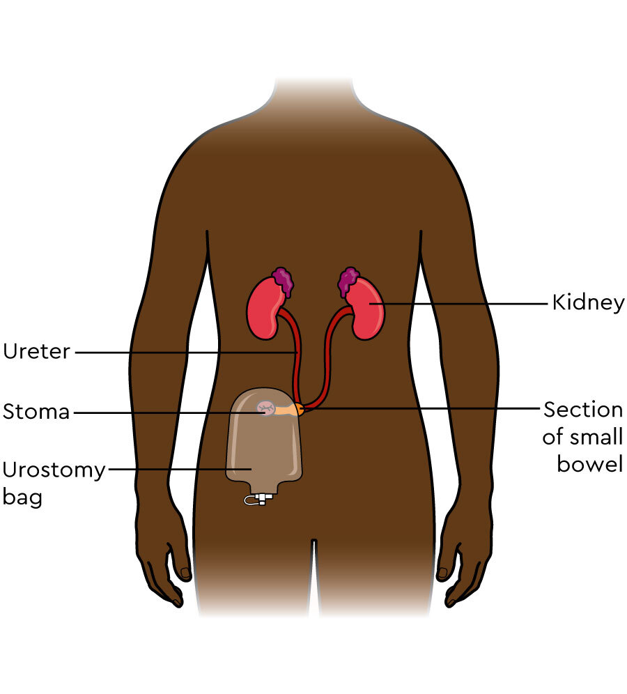 Continent Urostomy Guide Continent Urinary Diversion Treatment ACME