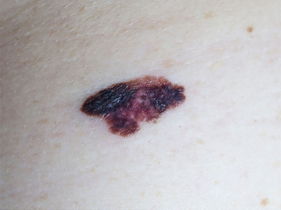A melanoma with different colours and some black areas