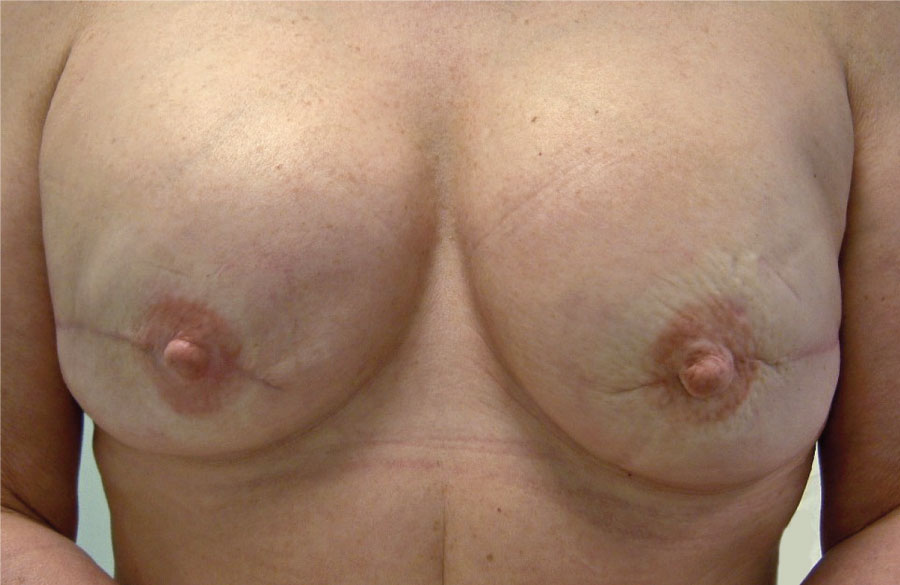 Reconstruction of both breasts with expander implants
