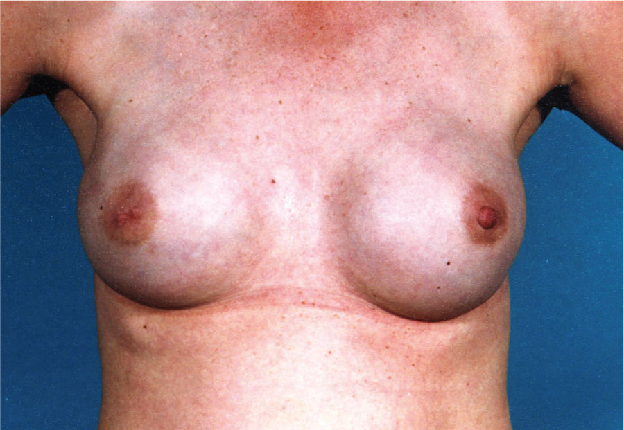 Reconstruction of both breasts with expander implants