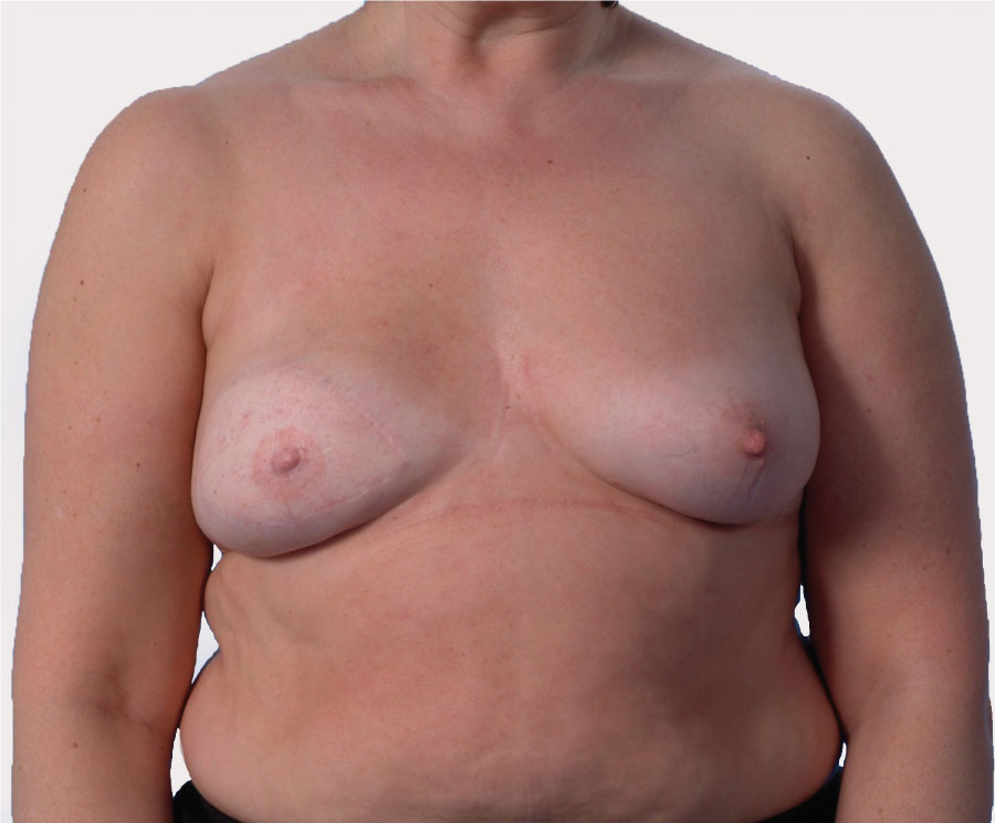 LD flap with nipple prosthesis, and the scar on the back