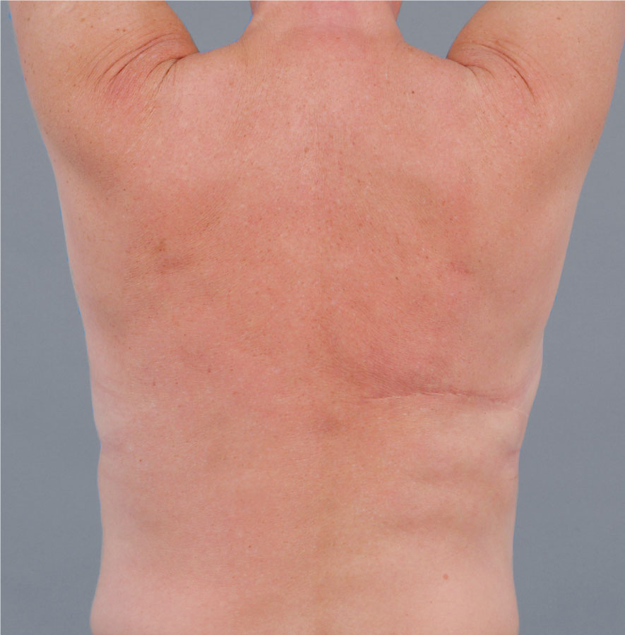 LD flap with nipple prosthesis, and the scar on the back