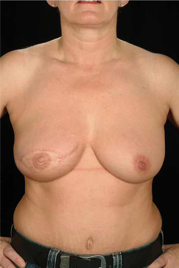 Immediate DIEP flap with nipple reconstruction and tattoo
