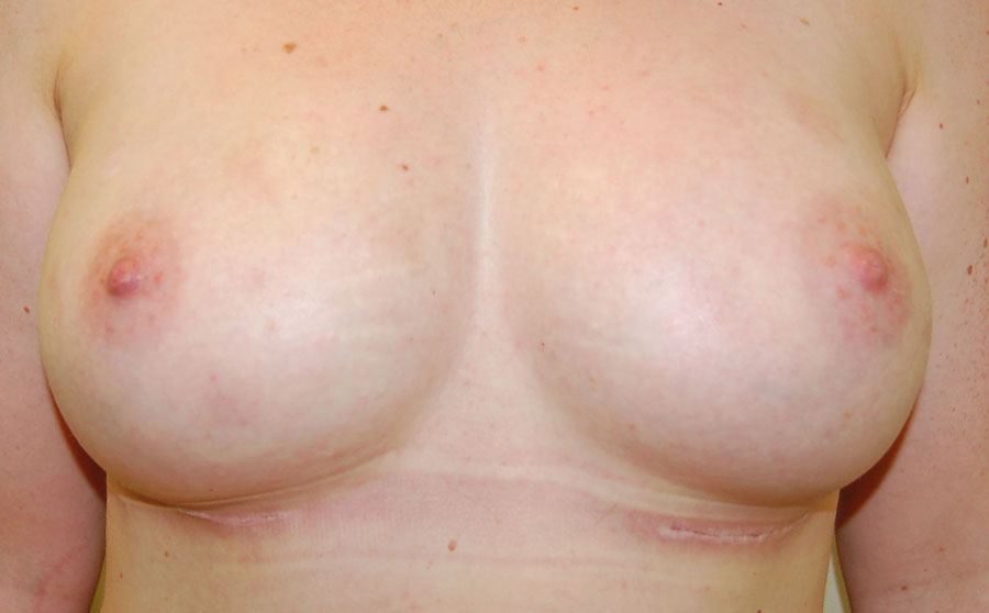 Bilateral nipple-sparing mastectomy with implants