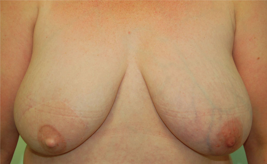LD flap with implant and nipple reconstruction