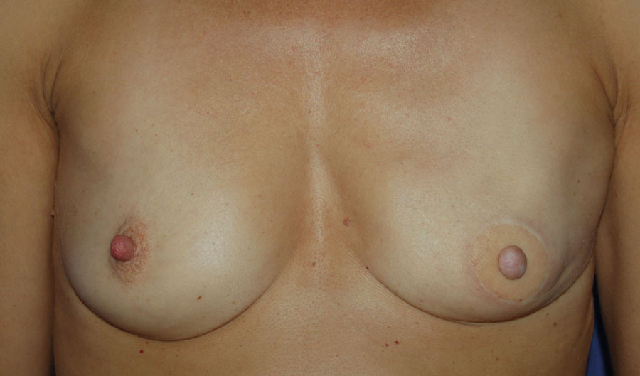 Left LD flap reconstruction and nipple graft