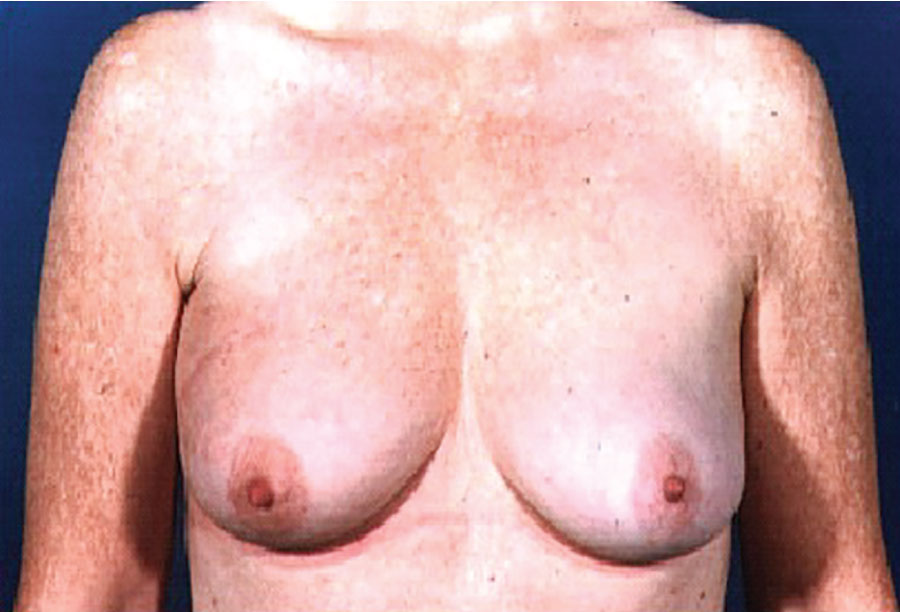 LD mini-flap reconstructions