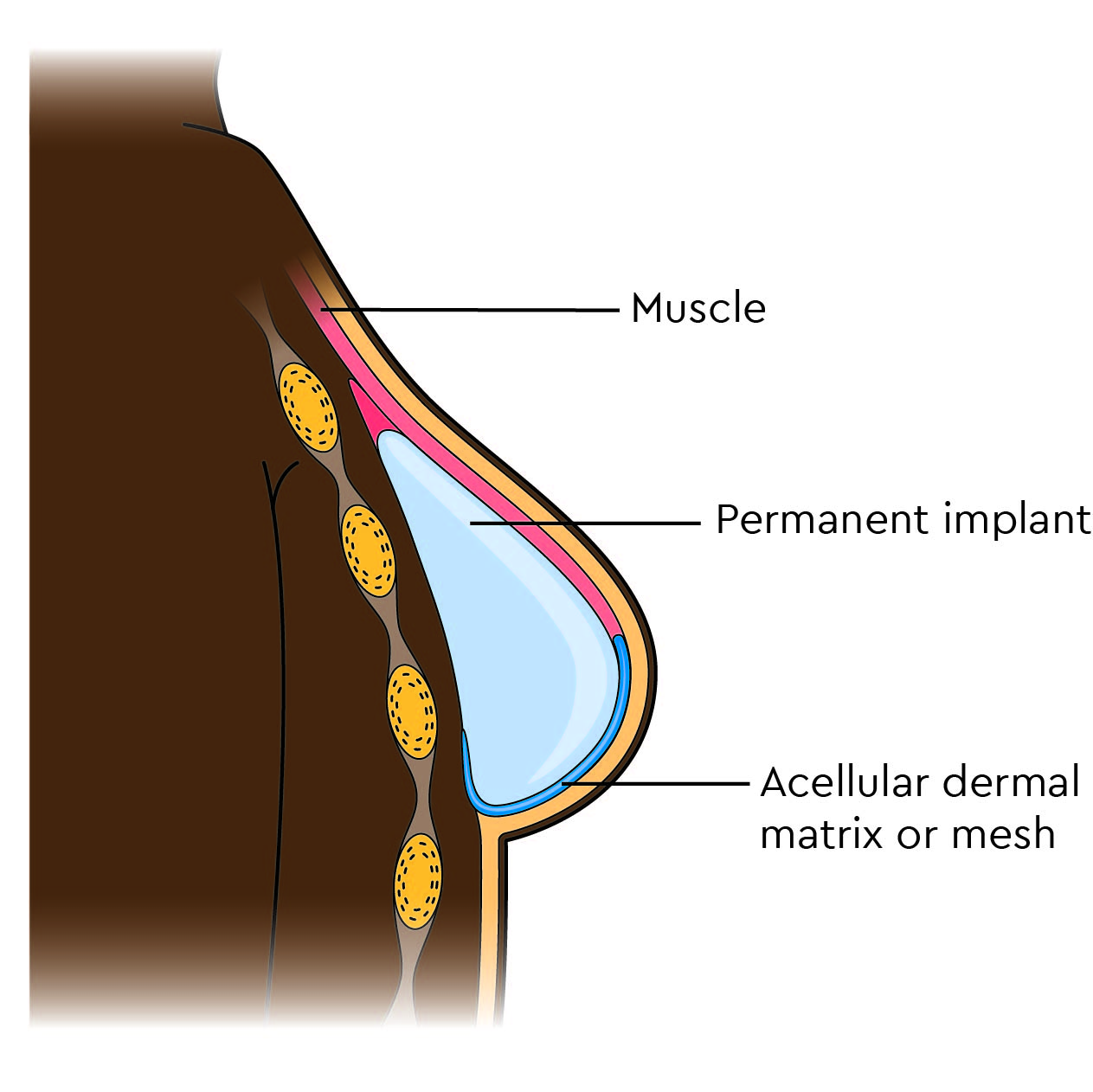 A permanent implant behind the chest muscle with ADM or mesh