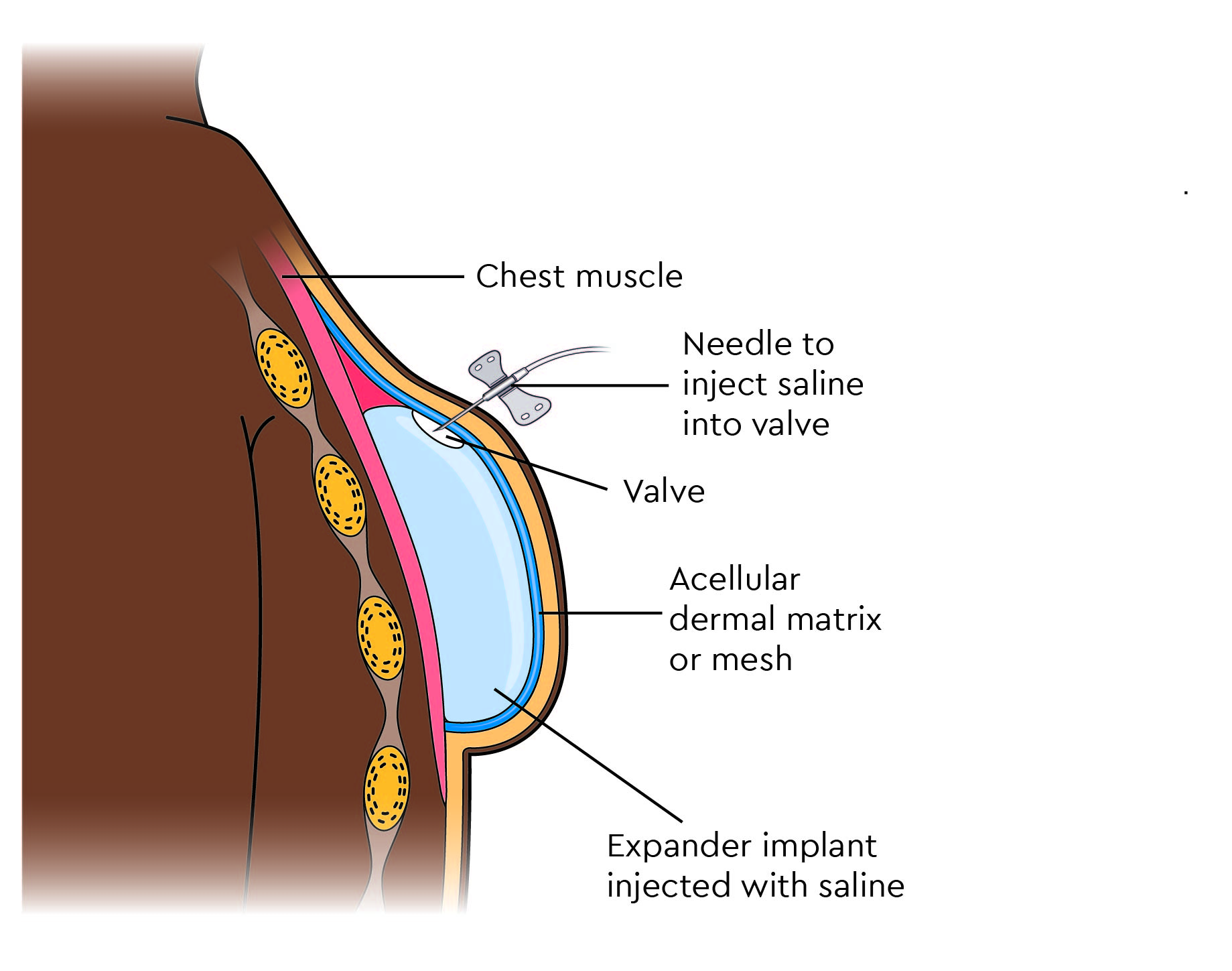 An expander implant with a valve placed in front of the muscle