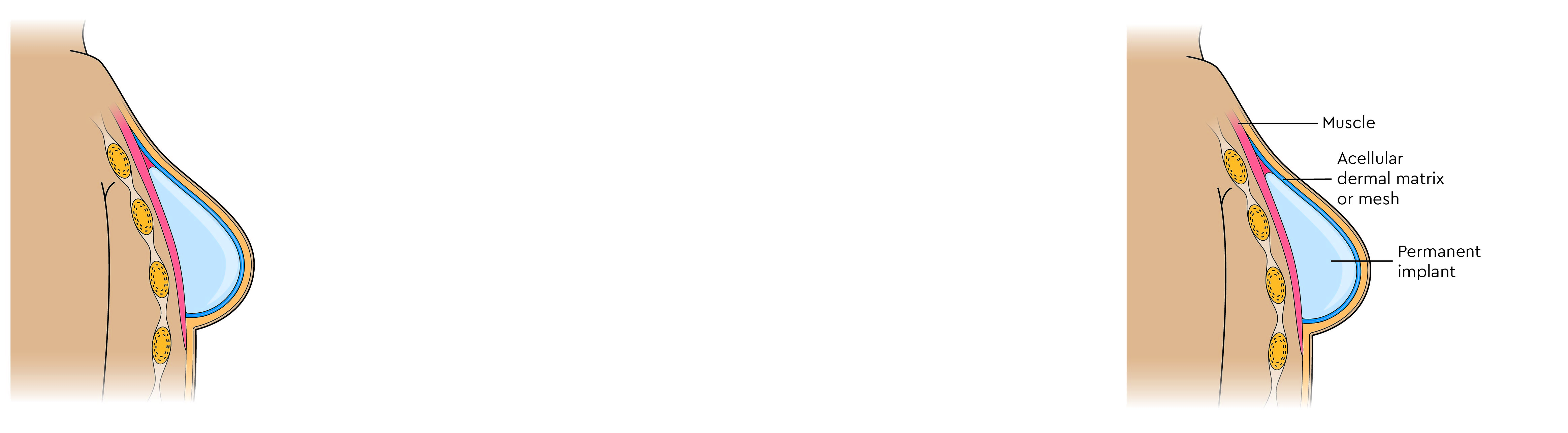 A permanent implant in front of the chest muscle with ADM or mesh