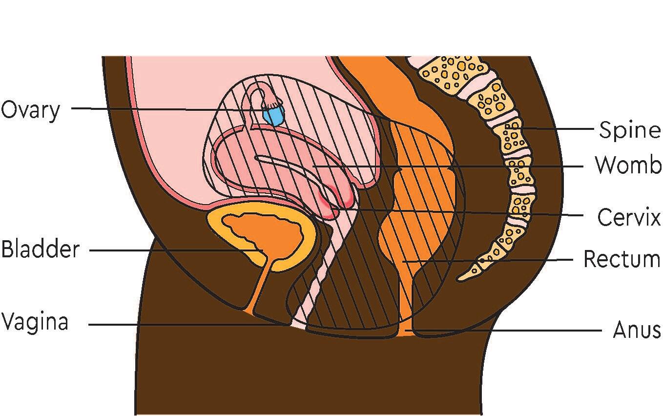 Pelvic exenteration for women and people assigned female at birth Macmillan Cancer Support