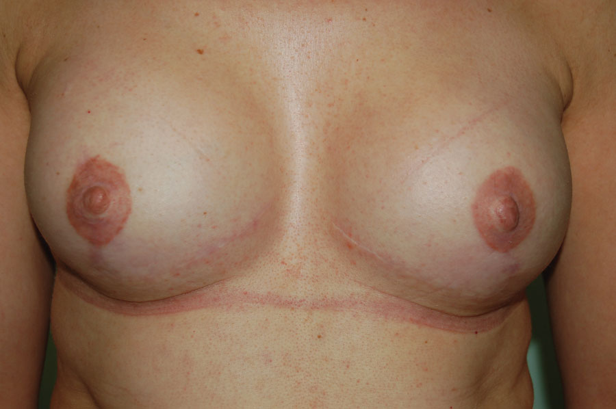 Bilateral mastectomy with implants and nipple reconstruction