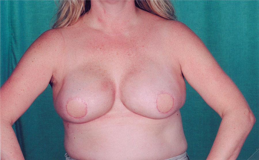 Front view 2 months after skin-sparing risk-reducing mastectomy using a LD flap (without nipple reconstruction)