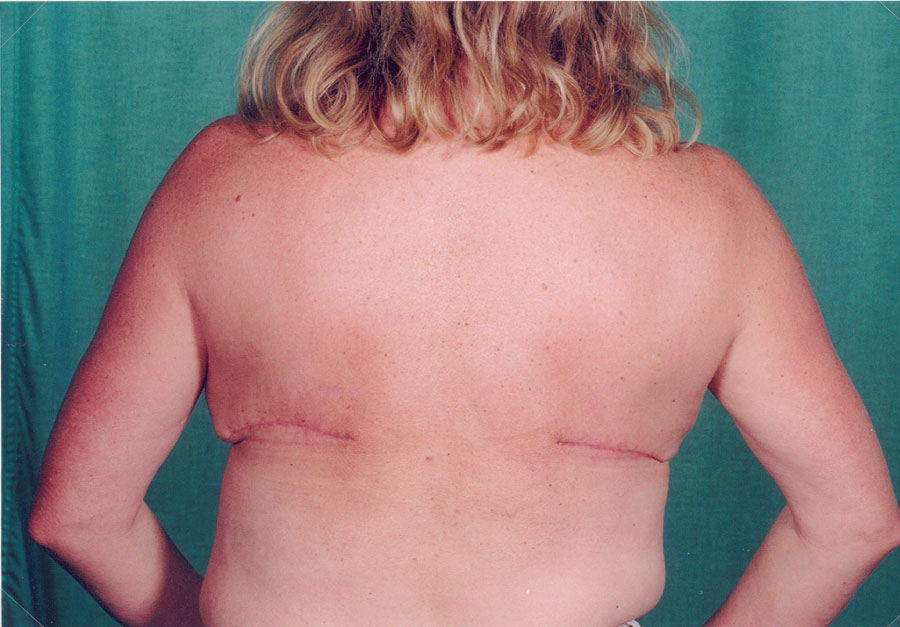 Back view 2 months after skin-sparing risk-reducing mastectomy using a LD flap (without nipple reconstruction)
