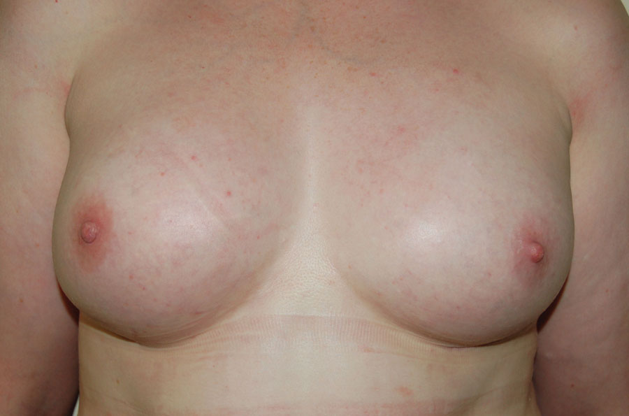 Bilateral mastectomies with implants and lipomodelling