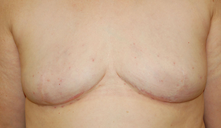 Goldilocks mastectomy with lipomodelling