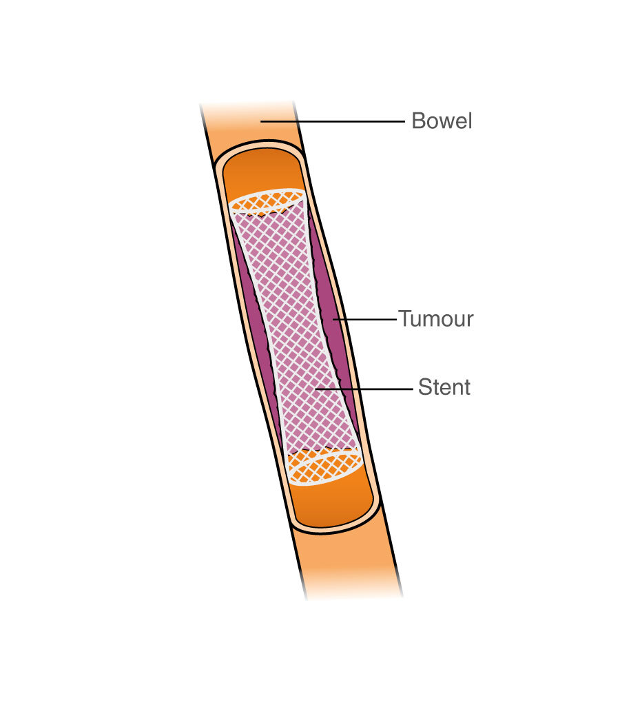 This diagram shows a mesh tube inside the bowel, pushing against the tumour and holding the bowel tube open.