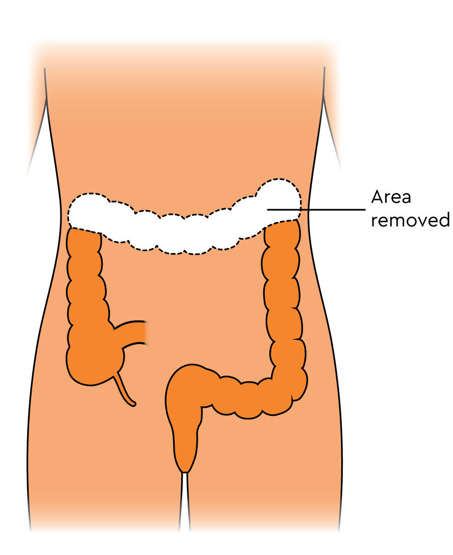 The diagram shows the colon. The top part is missing. The missing part is the transverse colon.