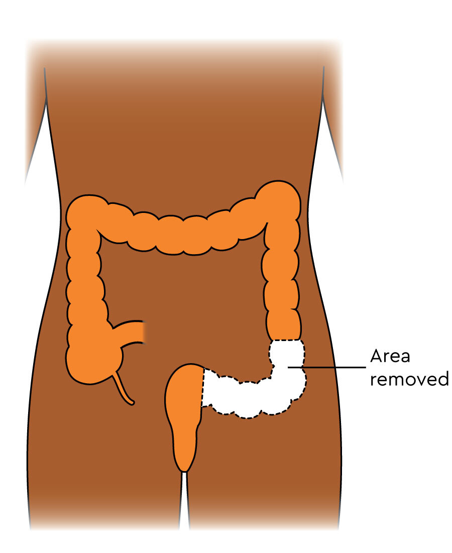 The diagram shows the colon. The bottom left is missing. The missing part is the sigmoid colon.