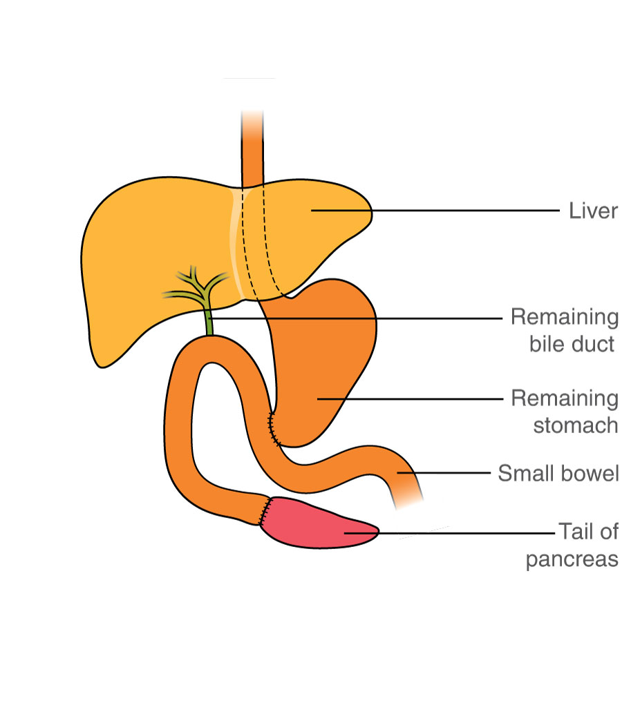 The remaining stomach, the bile duct and the tail of the pancreas are all attached to the small bowel in different places.