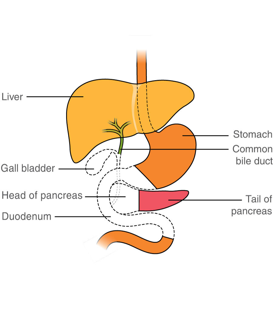 Surgery to remove distal bile duct cancer | Macmillan Cancer Support